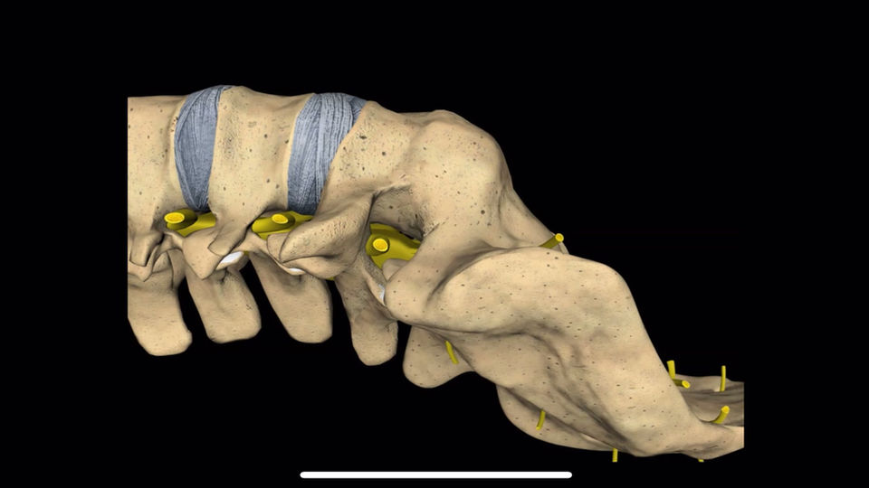 Goal of an Anterior Lumbar Interbody Fusion with cage (ALIF)